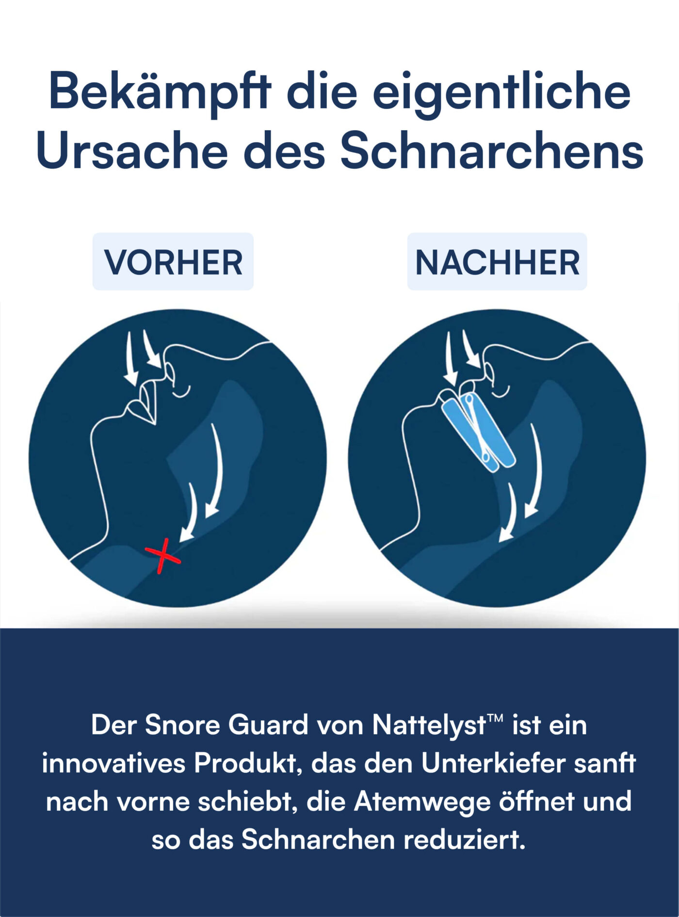 Schnarchschiene (Snore Guard)